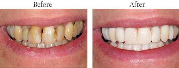 Before and After Teeth Whitening Marine Park