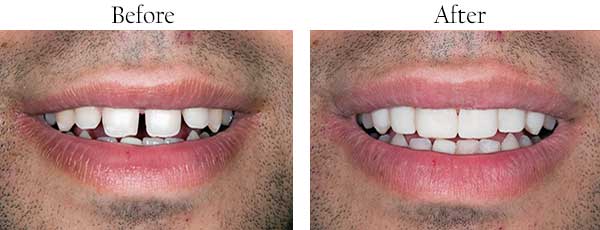 Before and After Dental Images 11229